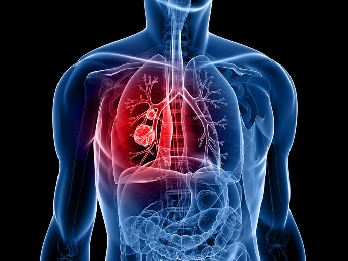 Los primeros tratamientos personalizados para el cáncer pulmonar